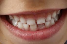 протезирование зубов у детей
